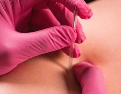Suche igłowanie – po co wbijać igłę, skoro i tak boli?